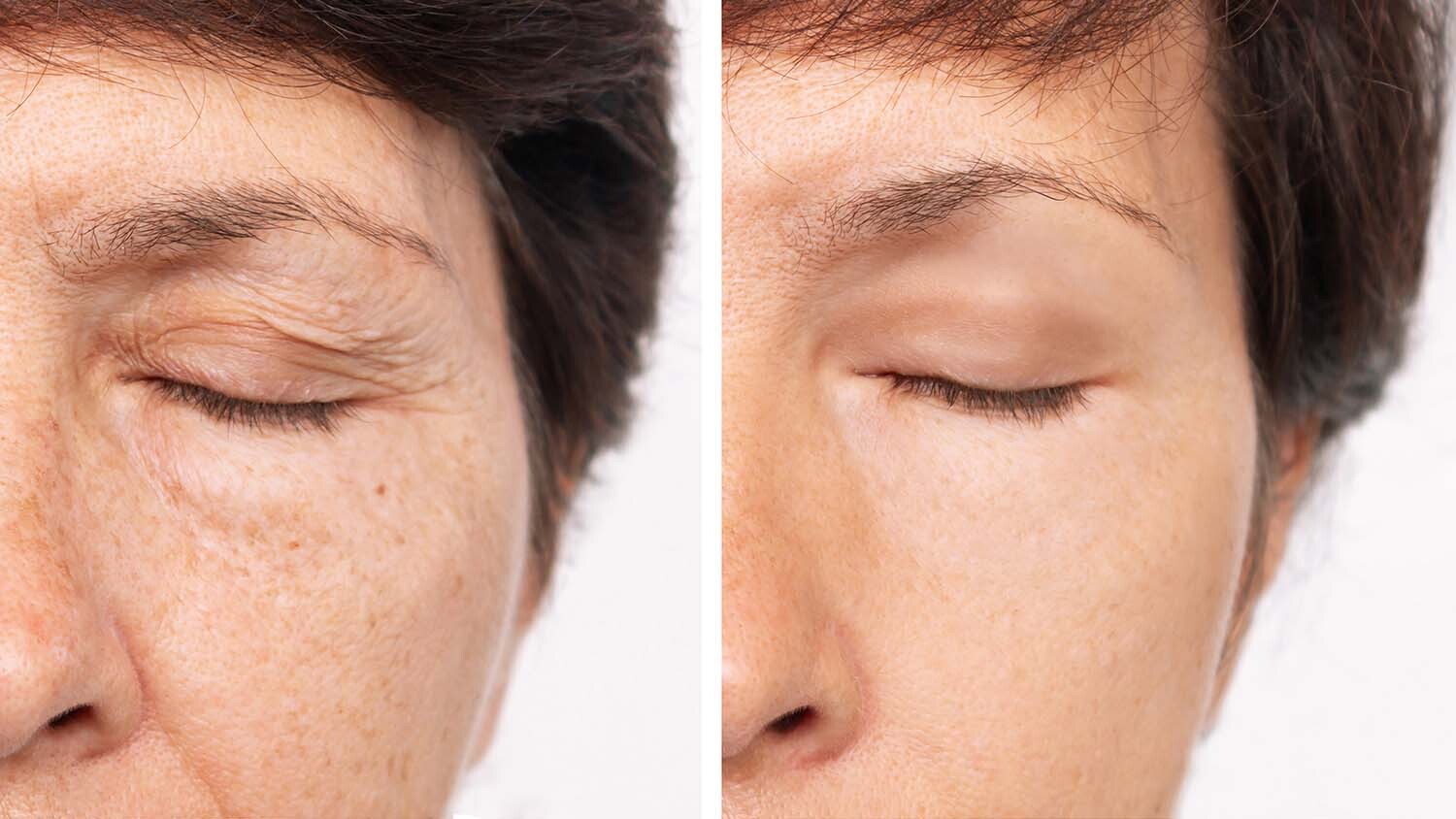 Announcement: Heavy eyelids and a tired look?  A simple process can make a big difference